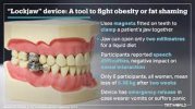 magnet teeth.jpg