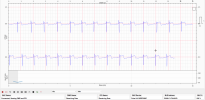 ecg_38kpy9wZf8.png