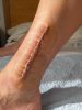 perone-post rimozione().jpg
